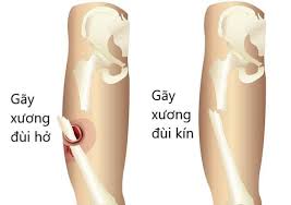 Ảnh 2 của Femoral Fracture